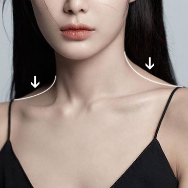 Botox shoulder contouring in Mississauga