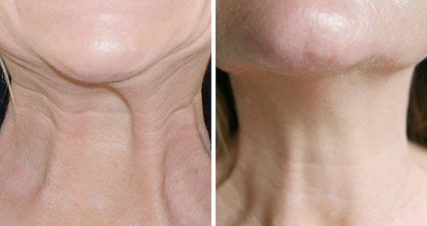 How Does Botox Nefertiti Lift Reduce the Sign of Aging?