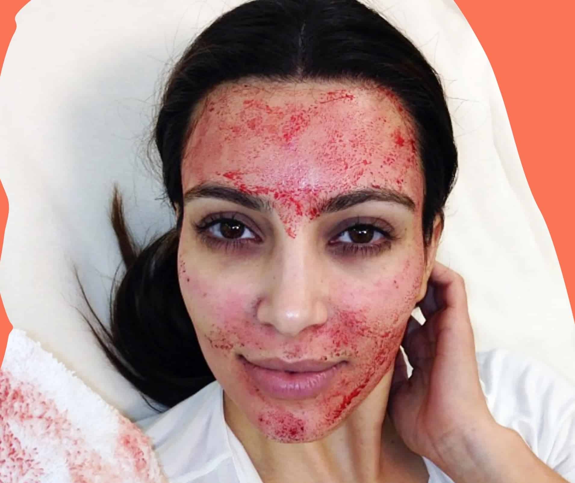Kim Kardashian during her vampire facial treatment
