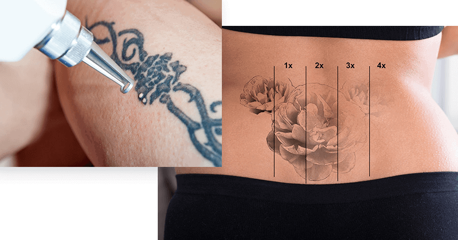 Tattoo removal in progress