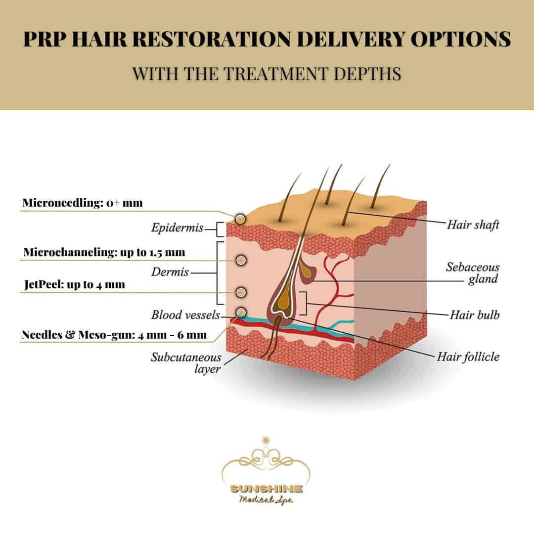 Different delivery options and their treatment depths for PRP hair restoration in Mississauga area, Ontario.