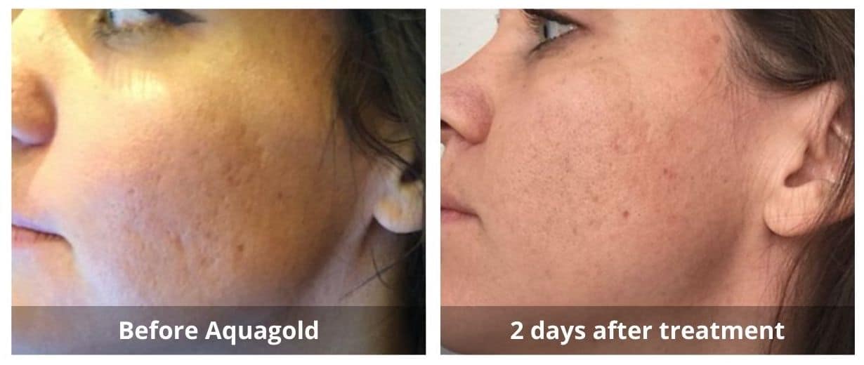 AquaGold® Fine Touch treatment