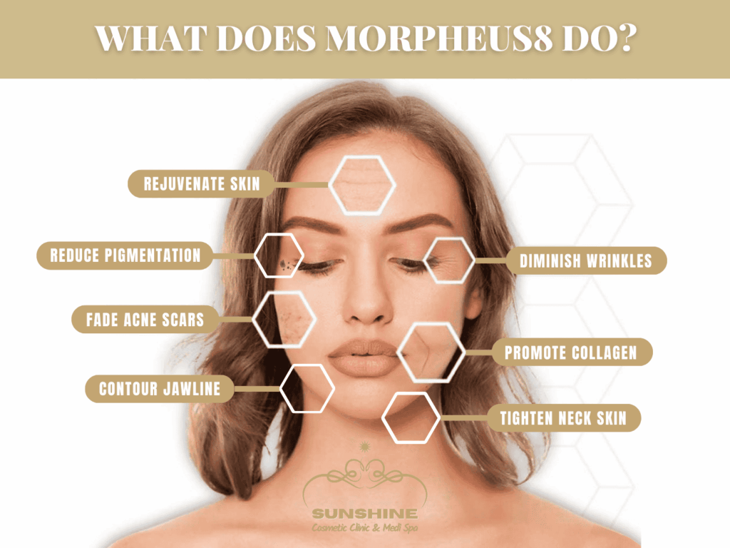 What does Morpheus8 do? Explained by Morpheus8 expert in Mississauga area
