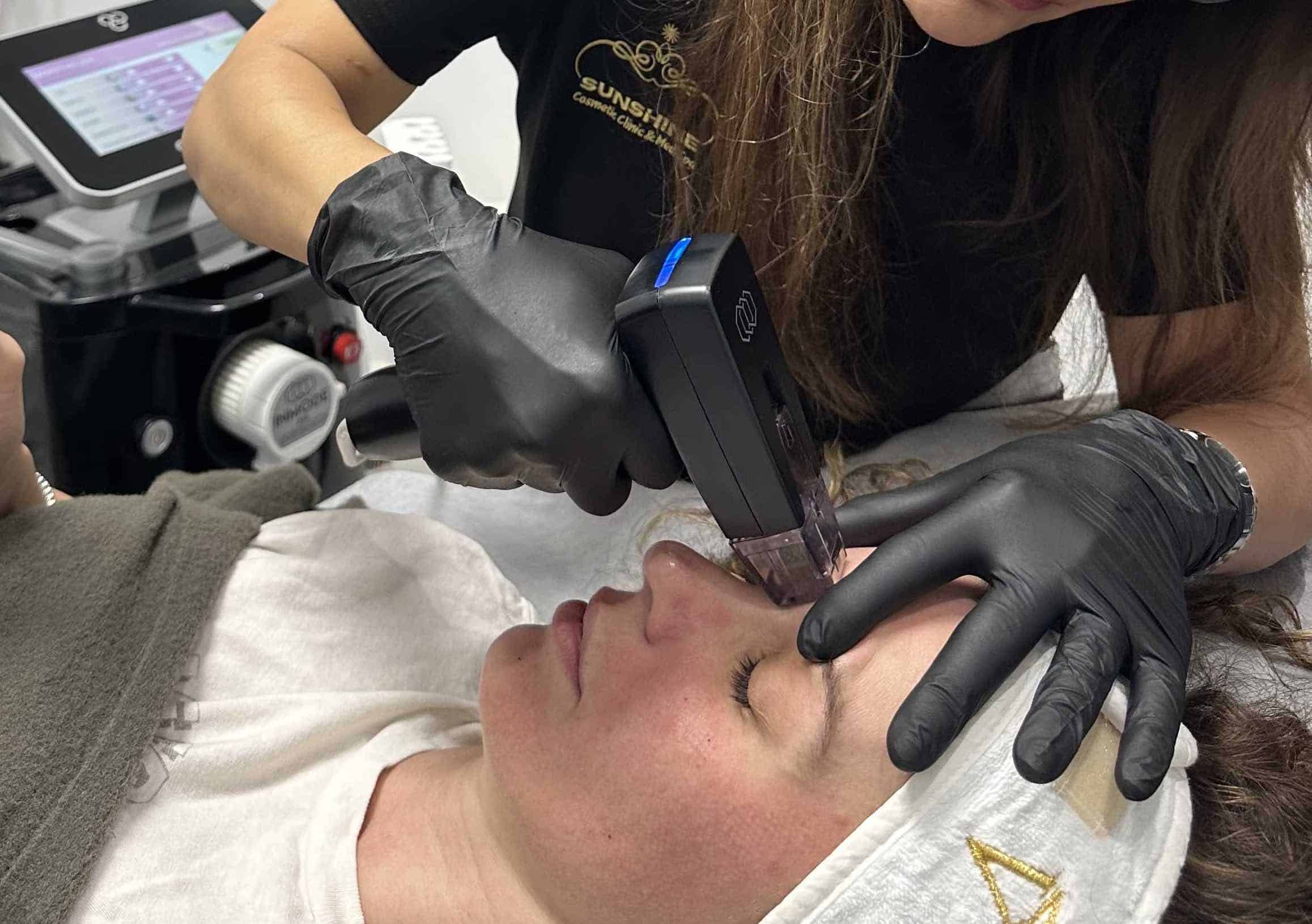 Morpheus8 treatment in progress at Sunshine Cosmetic Clinic & Medi Spa in Mississauga