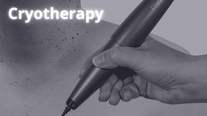 cryotherapy for men in Mississauga area