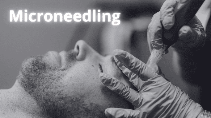 microneedling for men in Mississauga area