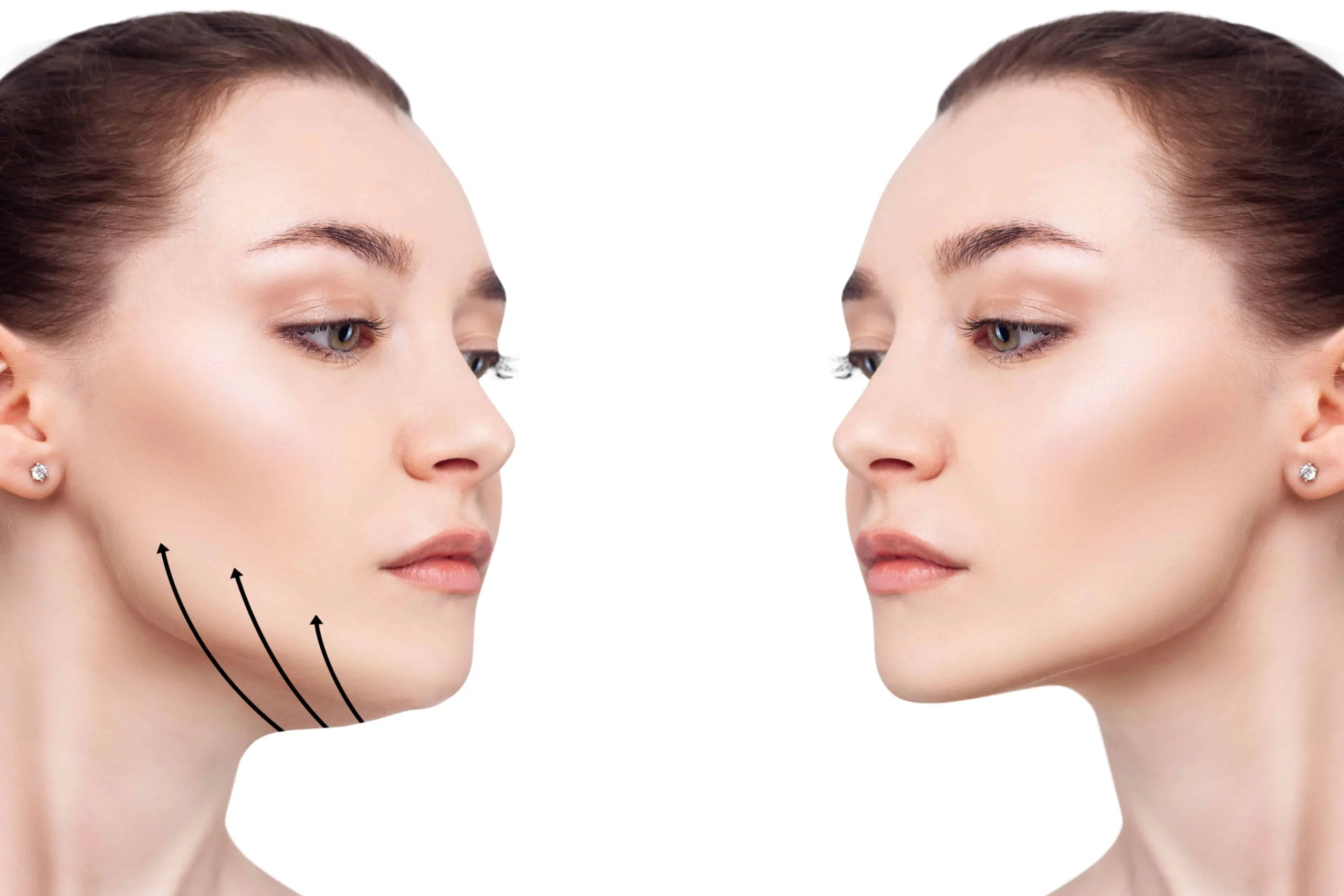 Say Goodbye to Your Double Chin: Exploring Effective Treatment Options