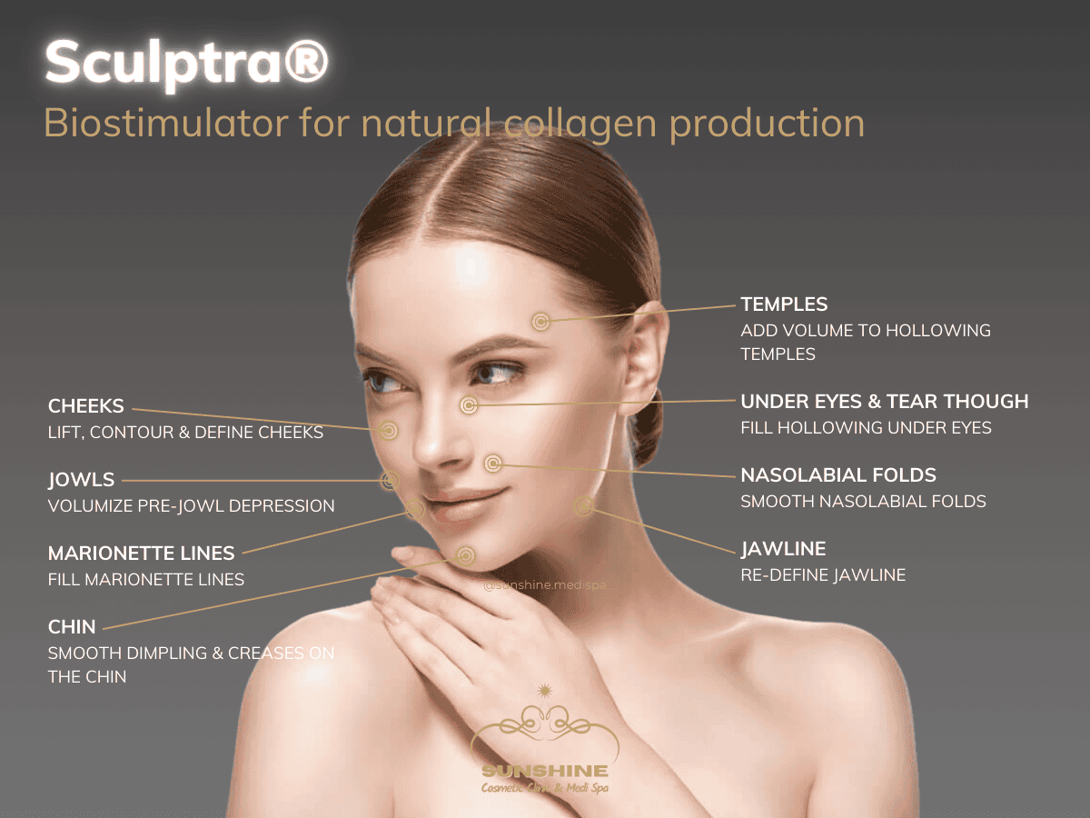 Sculptra Treatment Areas
