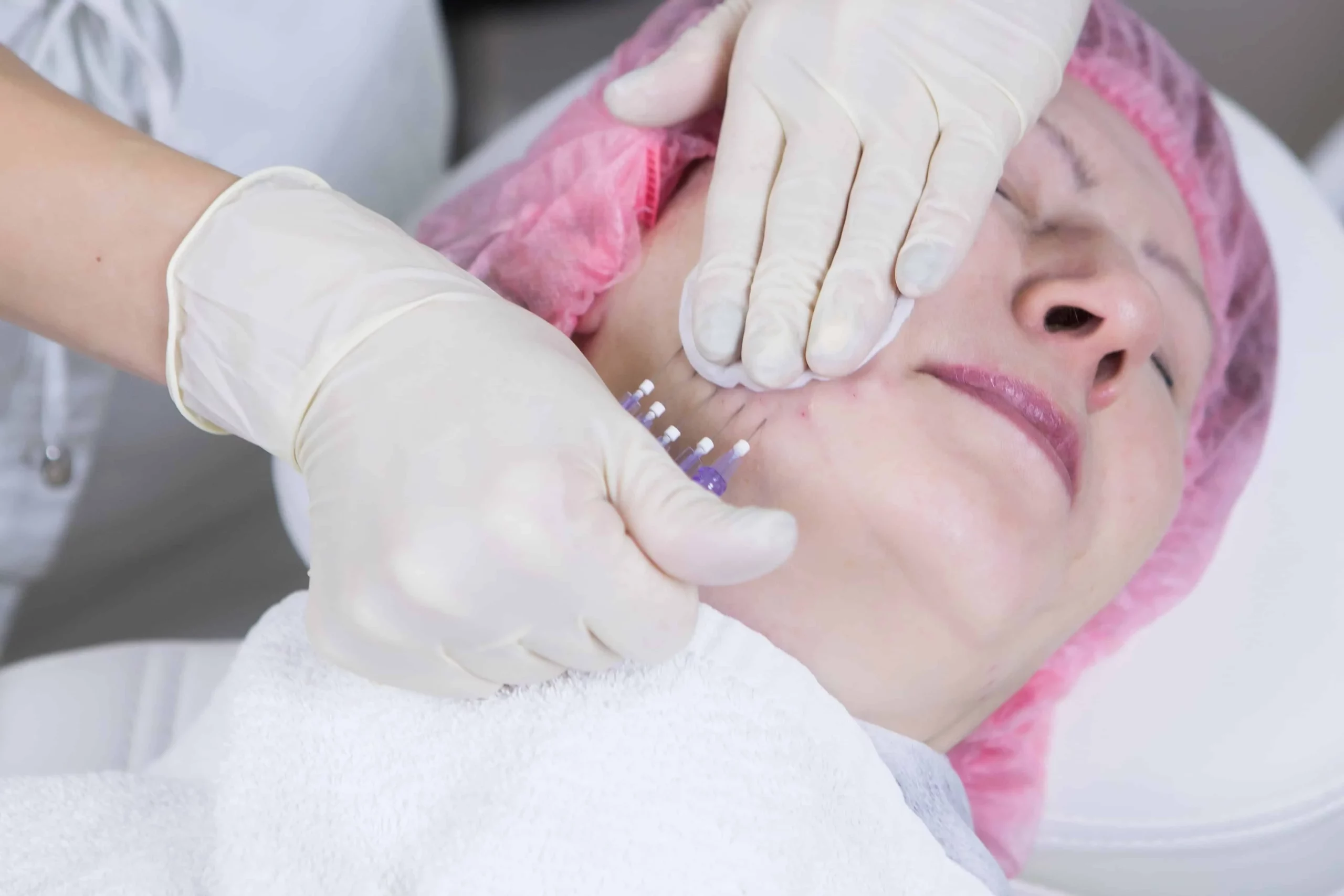 PDO Thread Lifts by Sunshine Cosmetic Clinic & Medi Spa in Waterloo ON