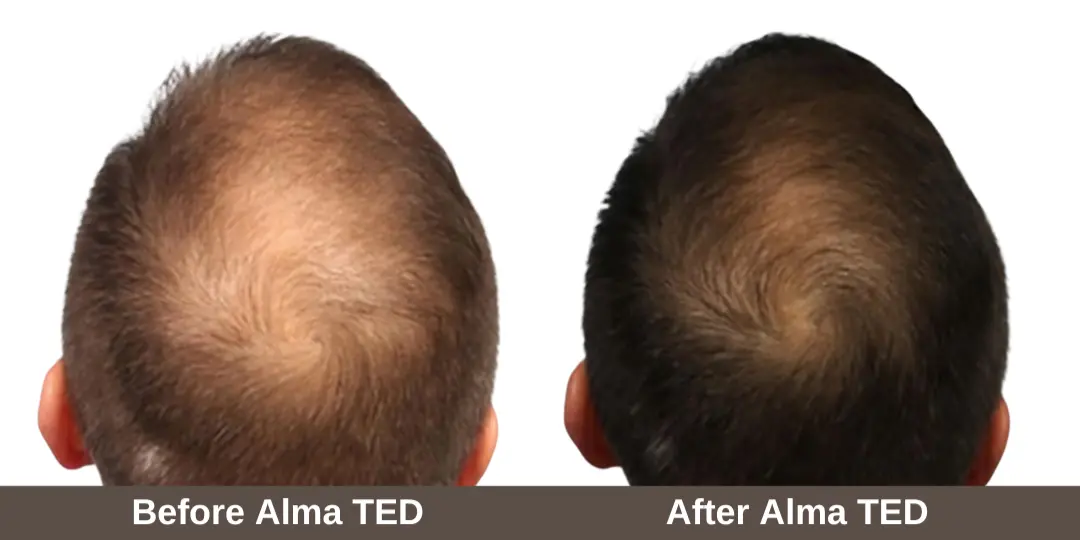 Hair Restoration Test