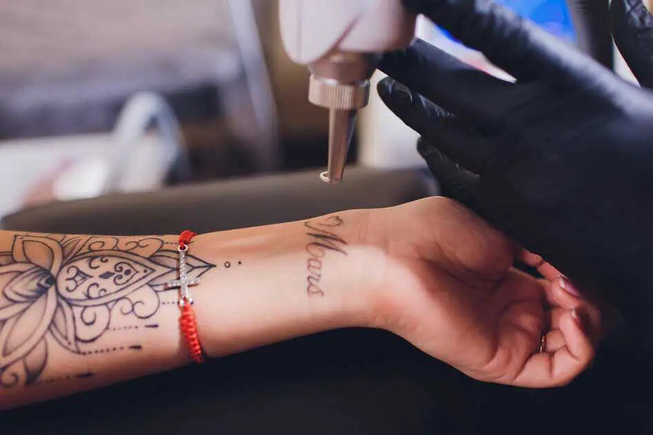 Tattoo Removal: How Safe is the Laser Treatment?