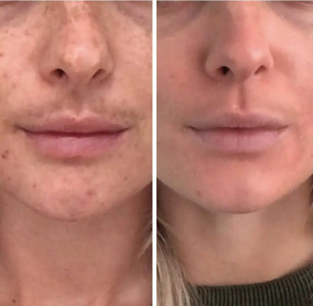 cosmelan-and-dermamelan-before-after