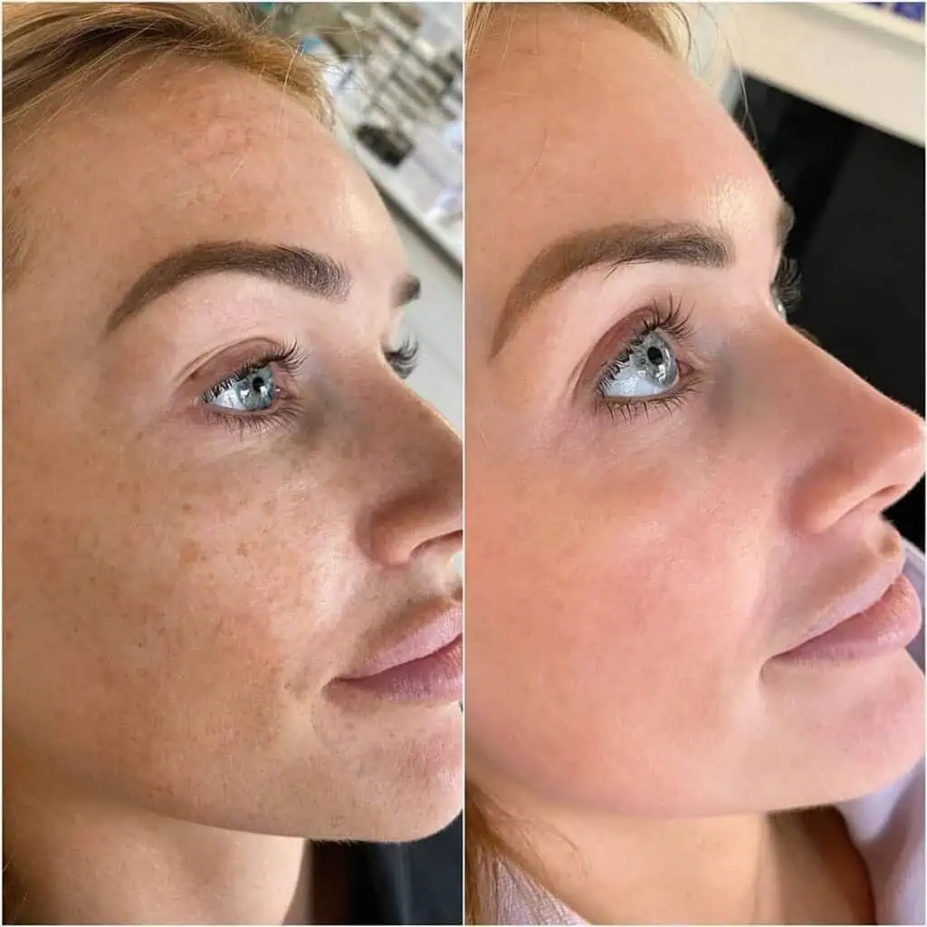 cosmelan-and-dermamelan-before-after