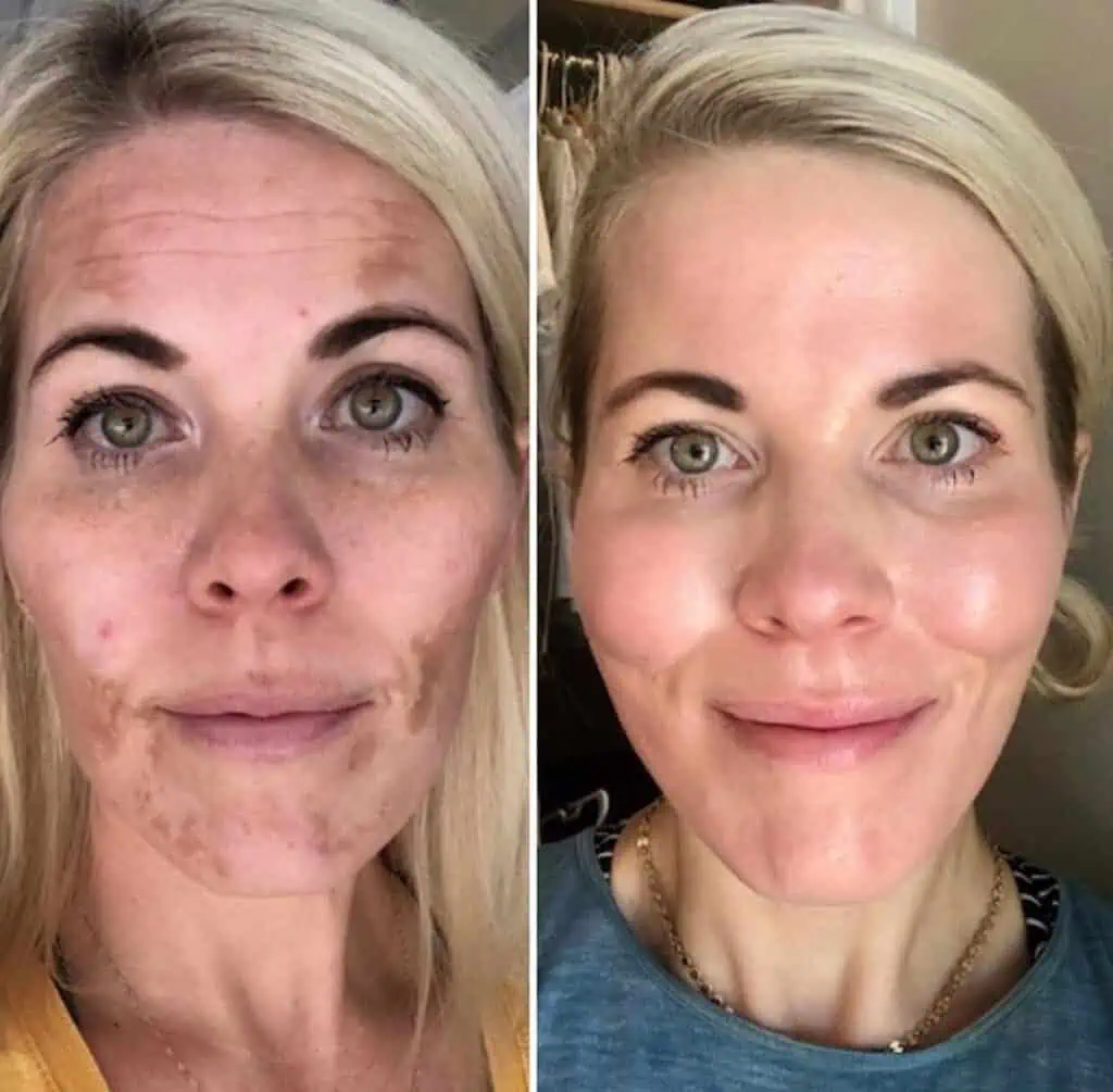 cosmelan-and-dermamelan-before-afterz