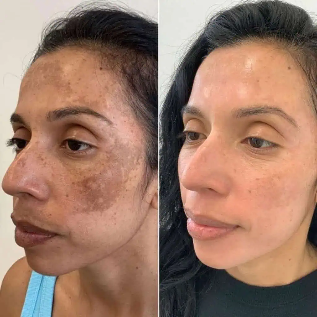 cosmelan-and-dermamelan-before-after