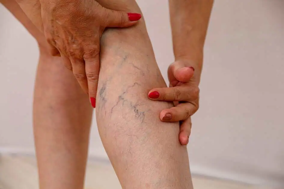 What Causes Spider Veins and How Can You Treat Them?