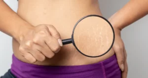 Close-up of a person examining stretch marks on their skin with a magnifying glass in Mississauga