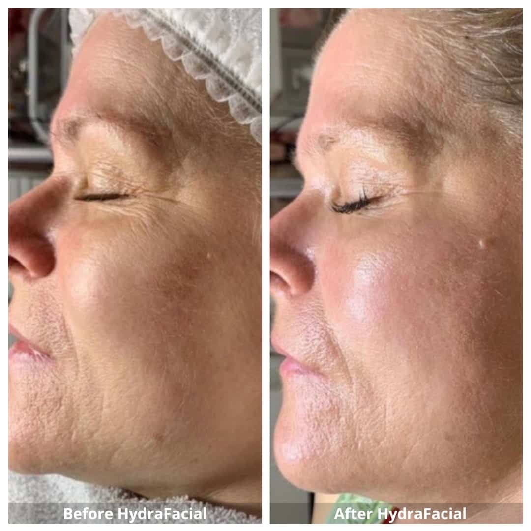 HydraFacial Mississauga