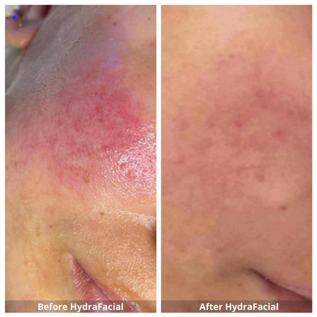 HydraFacial Mississauga