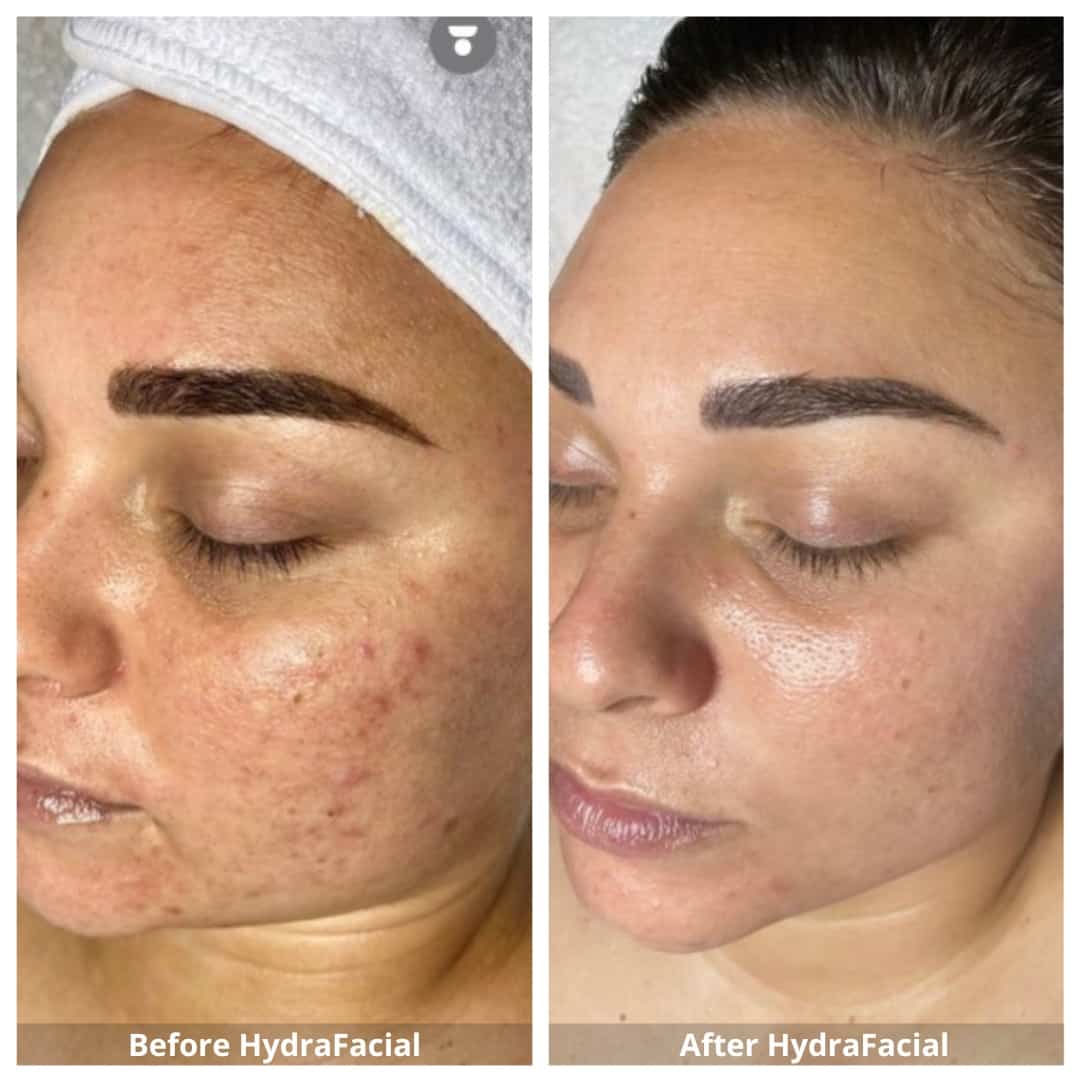 HydraFacial Mississauga